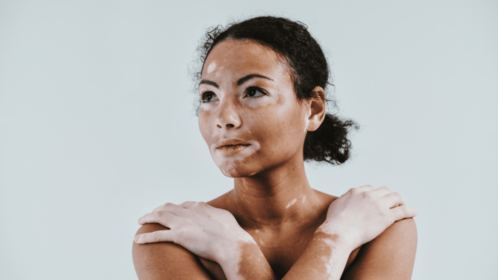 mujer con vitiligo